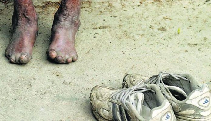 Supreme Court Seeks Centre Response On Laws Discriminating Against Leprosy Patients